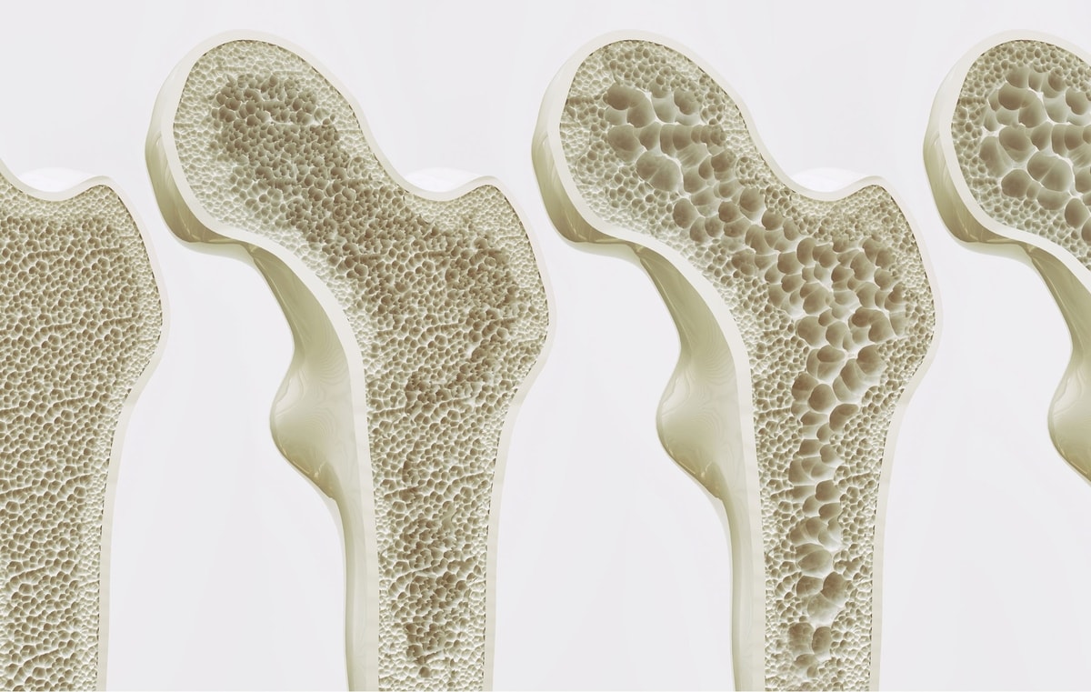 Osteoporosis: Penyakit Tulang yang Sering Diabaikan Osteoporosis: Penyakit Tulang yang Sering Diabaikan
