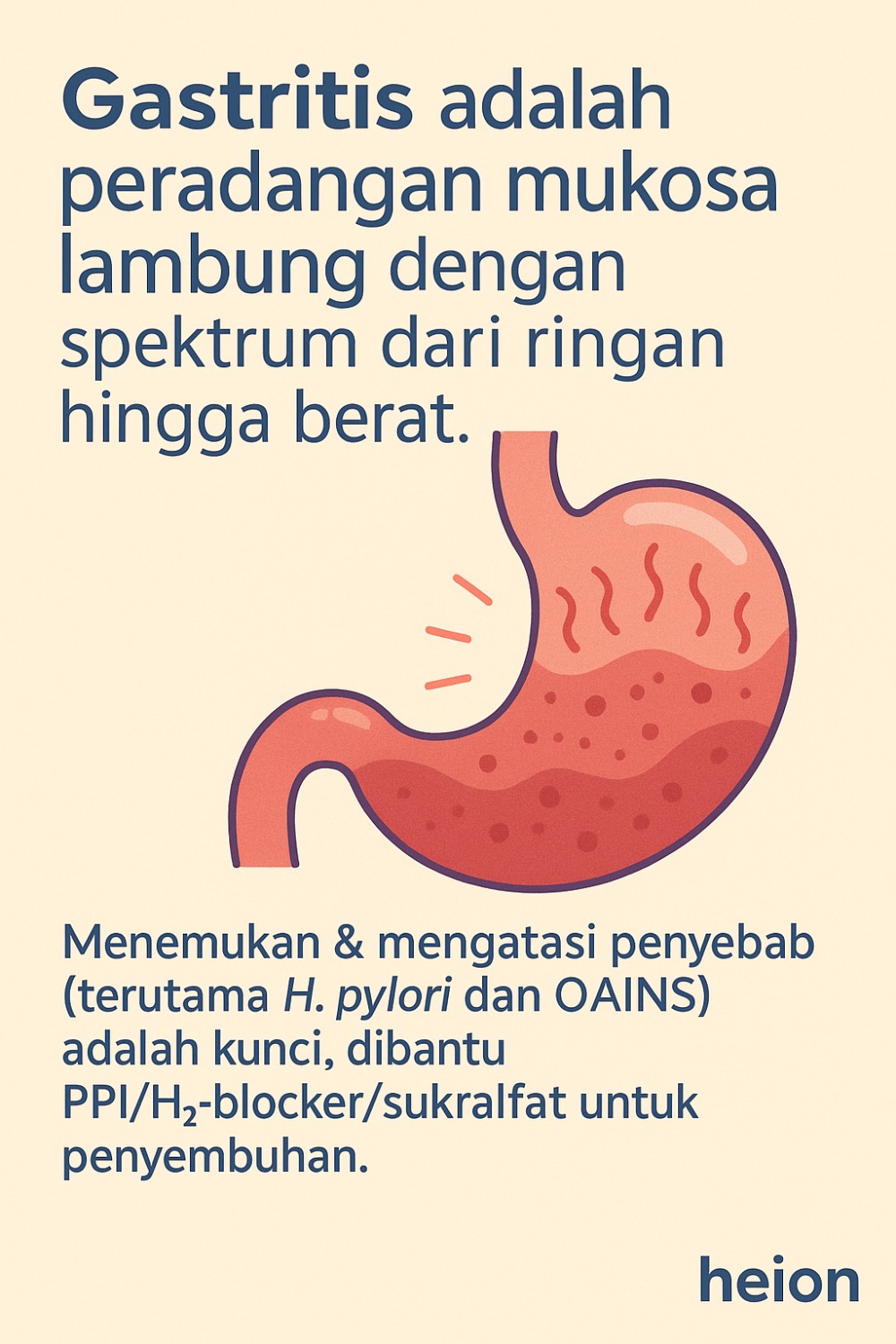 Inflamasi Lapisan Lambung (Gastritis): penjelasan medis, tata laksana, dan FAQ