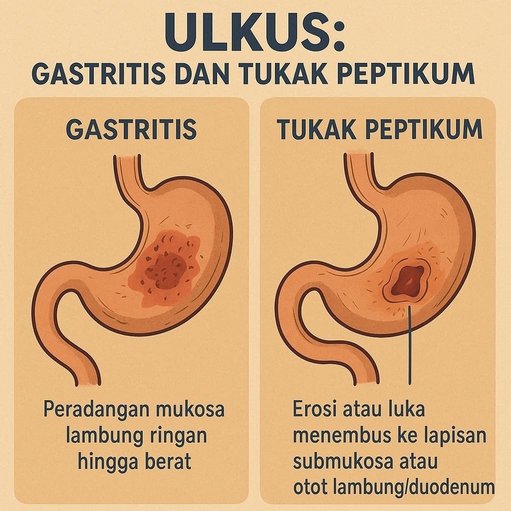 Dispepsia dan Hubungannya dengan Maag: Tinjauan Klinis