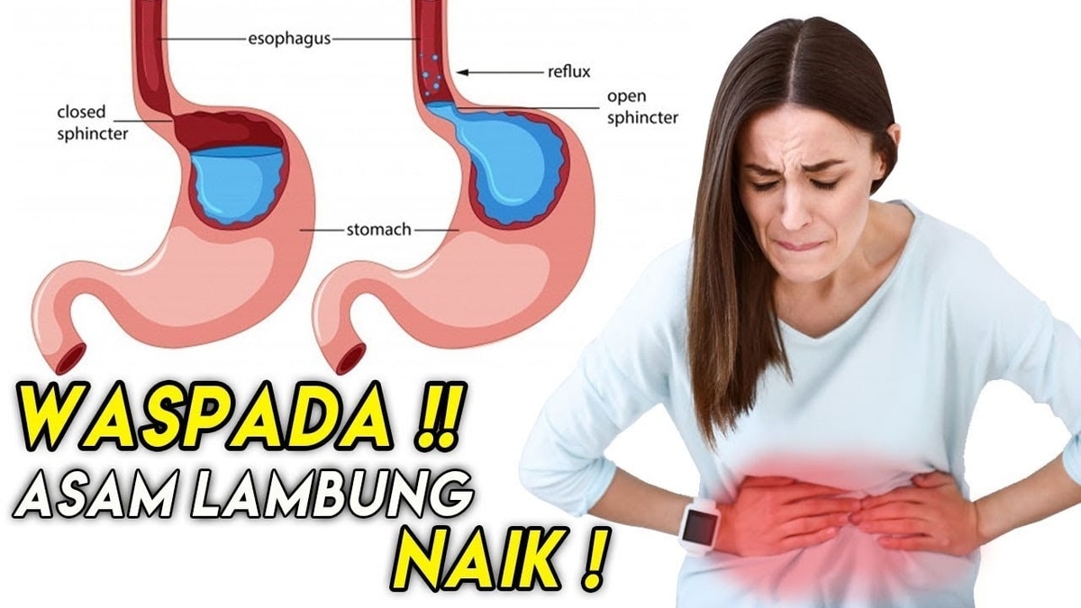 Waspada Asam Lambung Naik