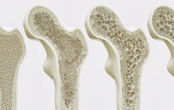 Osteoporosis: Penyakit Tulang yang Sering Diabaikan