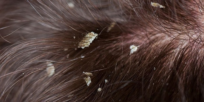 Tips Merawat Rambut Agar Terhindar Dari Ketombe
