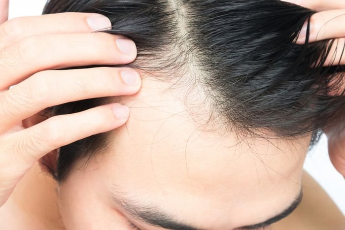 Cara Menumbuhkan Kembali Rambut Yang Mengalami Kebotakan