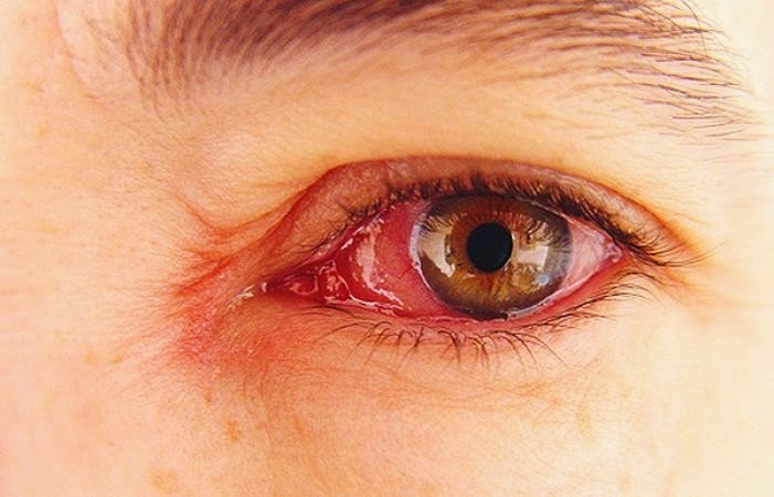 Mata Merah: Penyebab dan Solusinya
